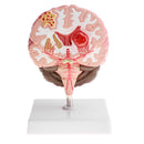 Minification 1X Human Brain Brainstem Cerebral Hemorrhage Diseased Pathological Model Teaching Model