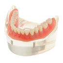 Oral Teeth Study Teach Demonstration Model Overdenture Inferior 2 Implant Demo Teaching Model - Clear Base
