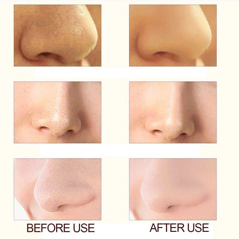 Electric Blackhead Remover Pore Vacuum Suction Diamond Dermabrasion Face