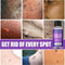 Wart Treatment Liquid Anti Verruca Remedy Warts Remover Removing Against Moles