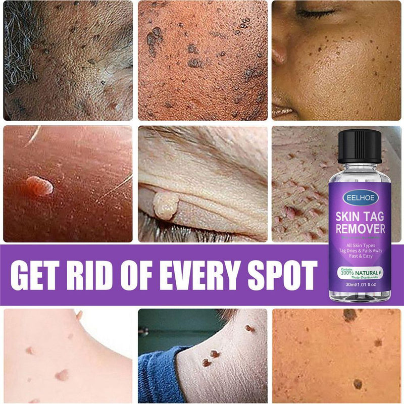 Wart Treatment Liquid Anti Verruca Remedy Warts Remover Removing Against Moles