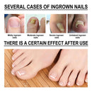 Ingrown Toenail Softener Serum Nail Correction Recover Oil Pain Reliever