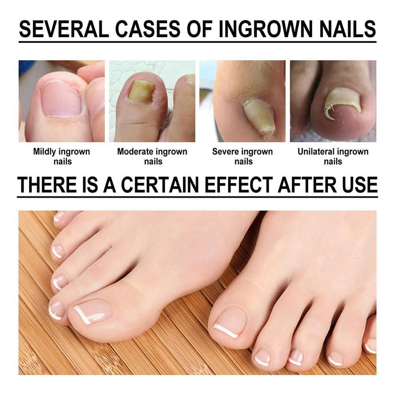 Ingrown Toenail Softener Serum Nail Correction Recover Oil Pain Reliever