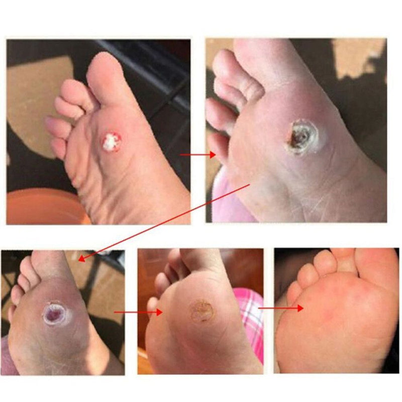 Wart Stick Wart Freeze Corn Removers For Feet Wart Remover Wart Remover Pads