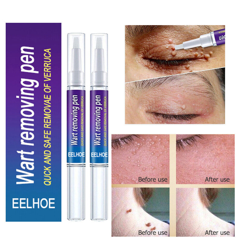 2pcs Wart Remover Skin Tag Pen Safe Herbal Ingredients Medicine Ointment Tools