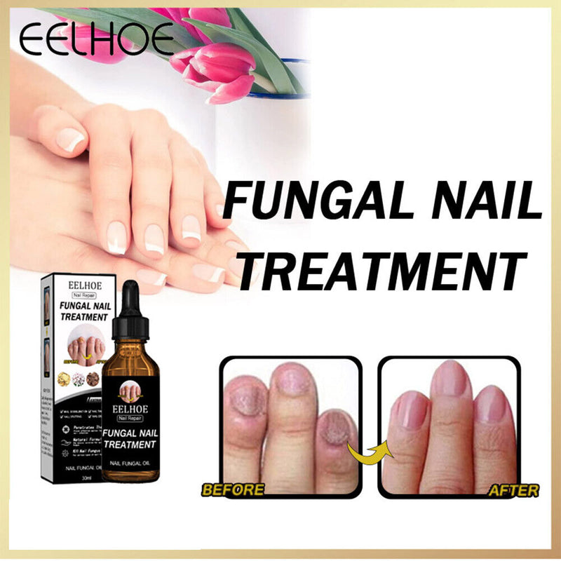 Nail Repair Fluid Health Care Foot Treatment Onychomycosis Paronychia Impro