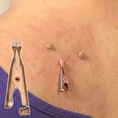 Micro Safe Skin Tag Remover Kit For Fast & Effective XAA Skin Tag 2021 R2V4