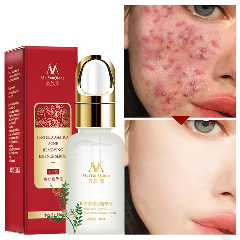 MEIYANQIONG Centella Asiatica Acne Removing Essence Skin Moisture Serum