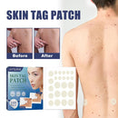Skin Tag Remover Patches Acne Pimple Moles Wart Remover 144 Pcs`