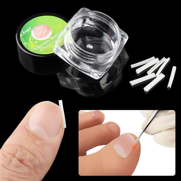 Prevent allergy Artifact Nail Groove Pad Ingrown Nail Pads Nail Corrector