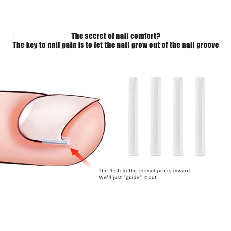 Ingrown Nail Filling Pad Relief Pain Nail Corrector Groove Pads (50pcs) Newly