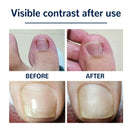 ?50pcs?2022 Fertoe Toenail Corrector Patch Ingrown Toe Nail Correction Stickers