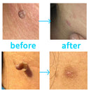 30pcs Skin Tag Remover Patch Kits Easy Clean Face Mole Band for Home Use Newly