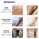 Varicose Vein Spray Blood Circulation Leg Acid Bilges Itching Solution 30ml