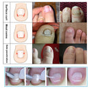 24pcs Nail Correction Tool Ingrown Toenail Paronychia Fixer Nail Paster Kit