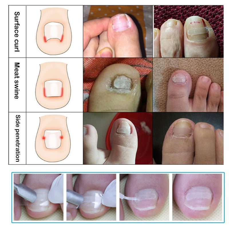 24pcs Nail Correction Tool Ingrown Toenail Paronychia Fixer Nail Paster Kit