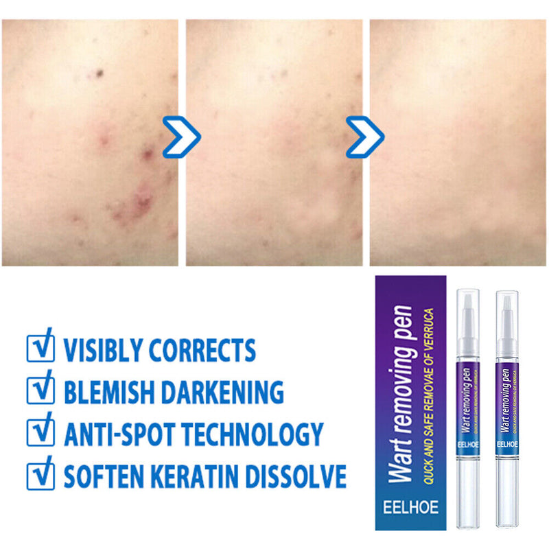 2pcs Wart Remover Skin Tag Pen Safe Herbal Ingredients Medicine Ointment Tools