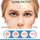 Master Acne Spot Treatment Ance Pimple Patches Skin Tag Remover Patch