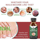 Fungal Nail Repair Essence Care Treatment Whitening Foot Nail Gel T6W5
