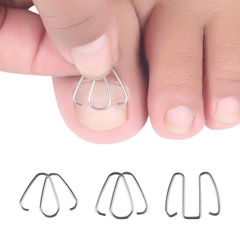 Front Nail Hook/Rubber Band Ingrown Toe Nail Correction Tool Orthosis Clips