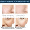 Lift Thread Chin Lift Thread Face Lifting Thread Collagen Silk Thread