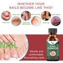 Nails Toes Care Painless Nail Fungus Treatment Nail Repair Liquid Fungus Serum