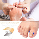 Paronychia Inlay Patch Painless Ingrown Toenail Correction Pedicure Nail Patch