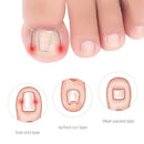 Ingrown Nail Groove Correction Hook Orthosis Paronychia Treatment Clip Corrector