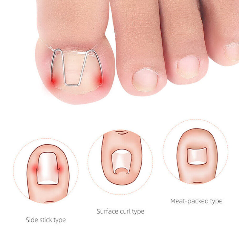 Ingrown Nail Groove Correction Hook Orthosis Paronychia Treatment Clip Corrector