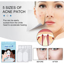 80pcs Acne Patches Pimple Remover Invisible Spot Stickers Facial Care Beauty