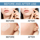 Pimple Patches Hydrocolloid Master Skin Tag Remover Patch Acne Spot Treatment