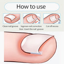 Prevent allergy Artifact Nail Groove Pad Ingrown Nail Pads Nail Corrector