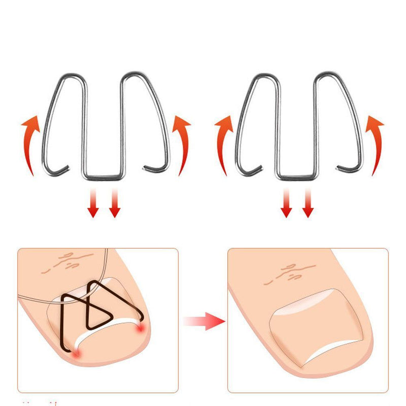 Easy To Use Correct Multiple Pedicure Front Hook Toenails Orthotics Rubber Band