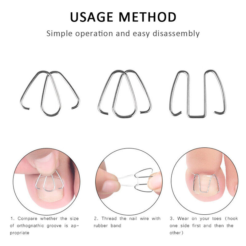 Ingrown Nail Groove Correction Hook Orthosis Paronychia Treatment Clip Corrector