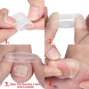 Straightening Clip Brace Medical Material Ingrown Toenail Correction Tool