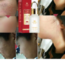 MEIYANQIONG Centella Asiatica Acne Removing Essence Skin Moisture Serum