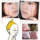 Extractor Comedone Stainless Steel Pimple Needles Blackhead Remover Tool