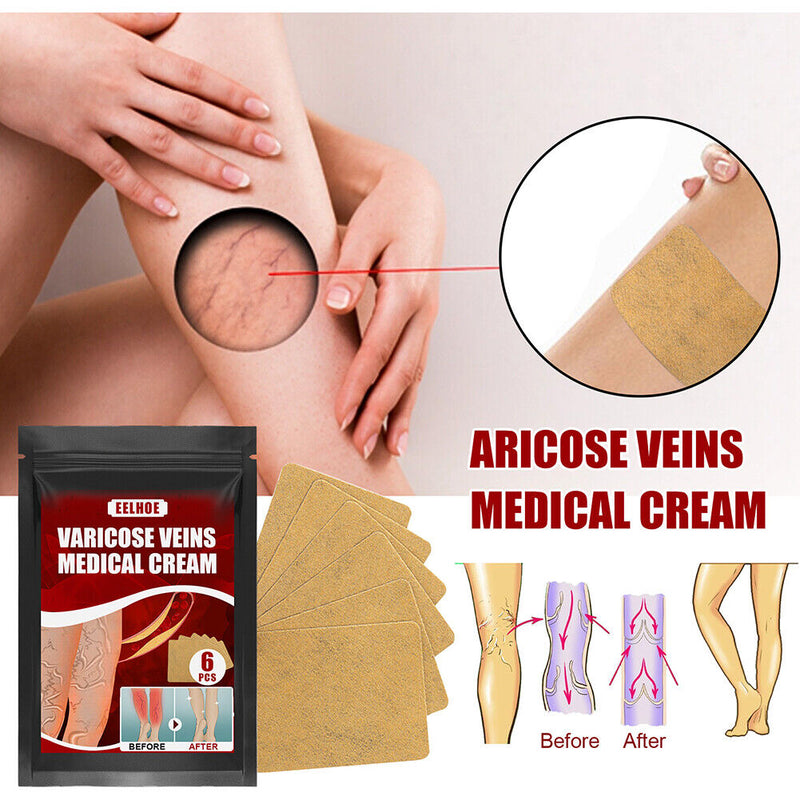 Body Vasculitis Phlebitis Spider Pain Relief Plaster Unisex Health Care Patch