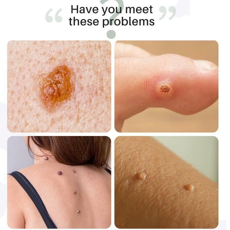 Fast-Acting Wart Remover Plantar and Genital Wart Treatment!