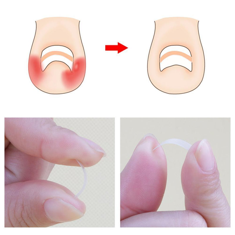 24pcs Nail Correction Tool Ingrown Toenail Paronychia Fixer Nail Paster Kit