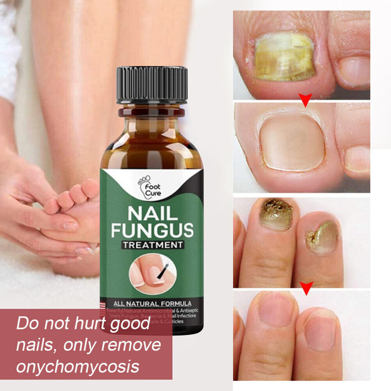 Nails Toes Care Painless Nail Fungus Treatment Nail Repair Liquid Fungus Serum