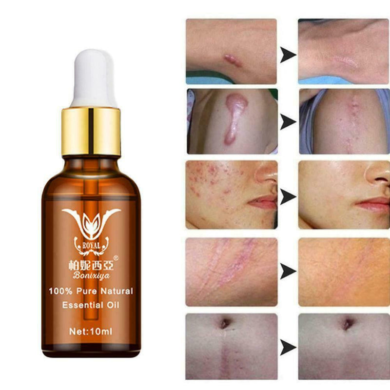 Stretch Marks Remover Essential Oil Eliminate Pregnancy Scars Maternity X7Y9
