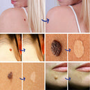Portable Skin Tag Remover Pen Wart Remover Acne Facial Skin Care Repair Tool