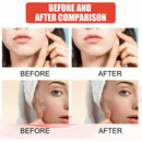 Master Ance Pimple Patches Acne Spot Treatment Skin Tag Remover Patch