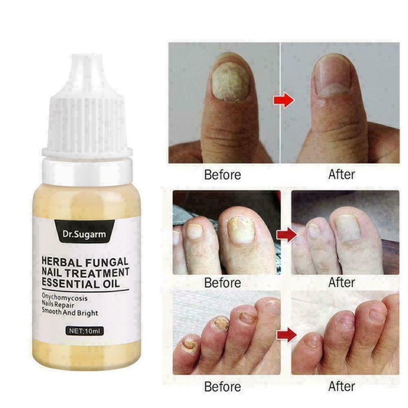 Nail Fungus Treatment Nail Oil Pen Anti Fungal Nail Remove Q4Y8 L0J1 C8K4
