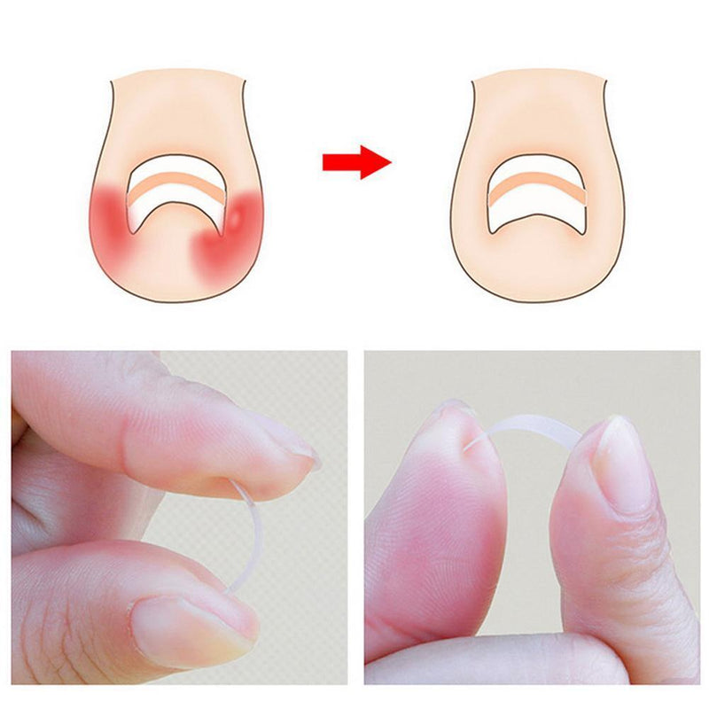 Ingrown Toenail Straightening Clip+Glue+Polish File Curved Brace Patch Kit