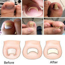 Effective Foot Care Pedicure Tools Set Ingrown Toenail Correction Paronychia