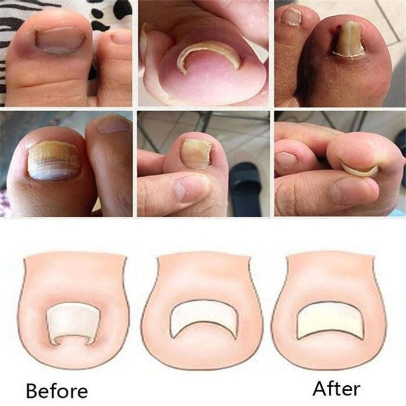 Effective Foot Care Pedicure Tools Set Ingrown Toenail Correction Paronychia