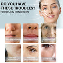 Lift Thread Face Lifting Thread Chin Lift Thread Collagen Silk Thread
