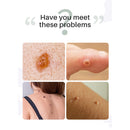 72pcs Warts Remover Skin Tags Pimple Hydrocolloid Gel Acne Plaster Patch